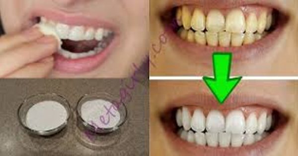 Featured Image for Επιβεβαιωμένο! Λευκάνετε τα κίτρινα δόντια σας σε λιγότερο από 2 λεπτά!