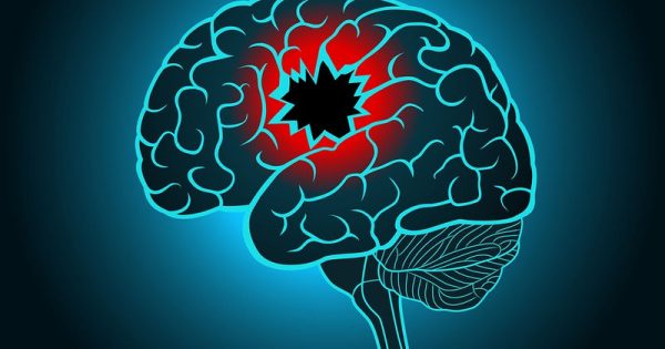 Αυξάνονται οι παράγοντες κινδύνου για εγκεφαλικό – Ποιοι είναι οι βασικοί