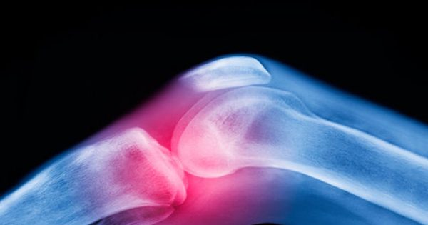 Οστεοαρθρίτιδα γόνατος: Οι 3 ασκήσεις που αυξάνουν τον κίνδυνο