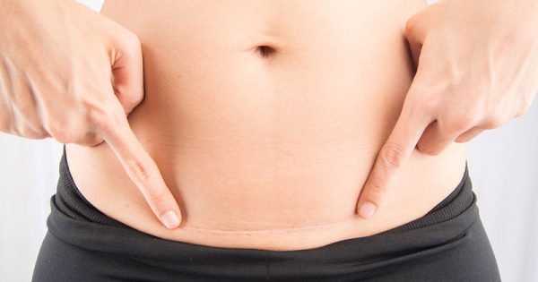Καισαρική: Το μέγεθος της τομής καθορίζει τον μετεγχειρητικό πόνο