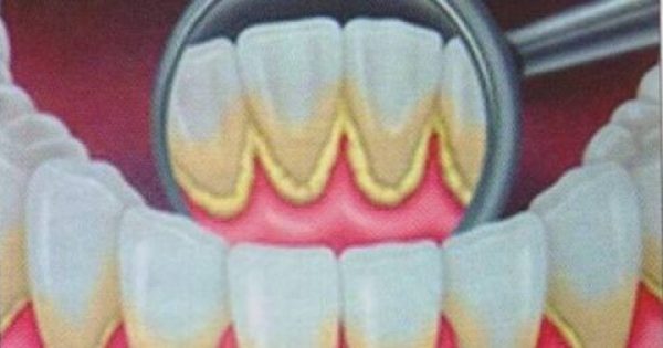 Απομακρύνετε την οδοντική πλάκα με φυσικό τρόπο
