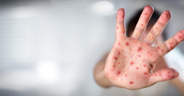 477 κρούσματα ιλαράς- Δεν έχουν εμβολιαστεί ακόμα και γιατροί- νσοηλευτές