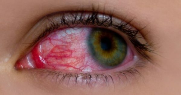 Ραγοειδίτιδα: Αίτια και συμπτώματα της πιο άγνωστης ασθένειας των ματιών
