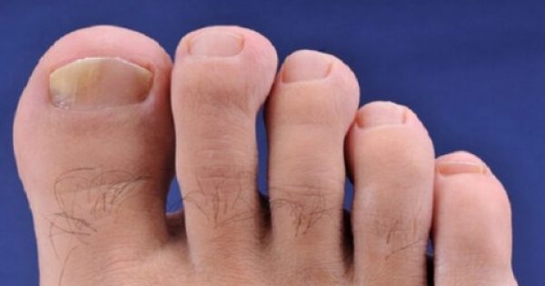 Σπιτικές θεραπείες για την ονυχομυκητίαση (Χεριών και ποδιών)