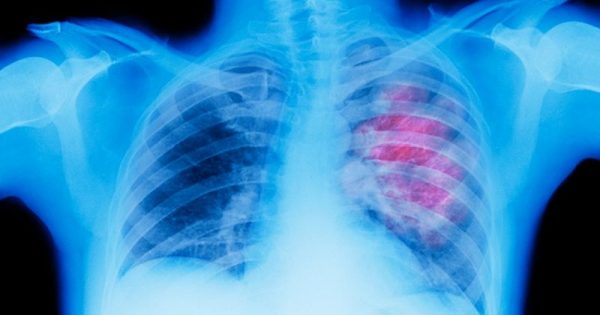 Σύγχρονη μάστιγα ο καρκίνος του πνεύμονα αλλά βρισκόμαστε στην αρχή του …τέλους του