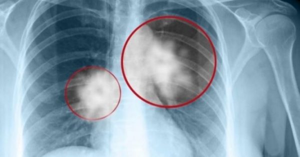 Καρκίνος πνεύμονα: Νέα ελπιδοφόρα αποτελέσματα από κλινική μελέτη