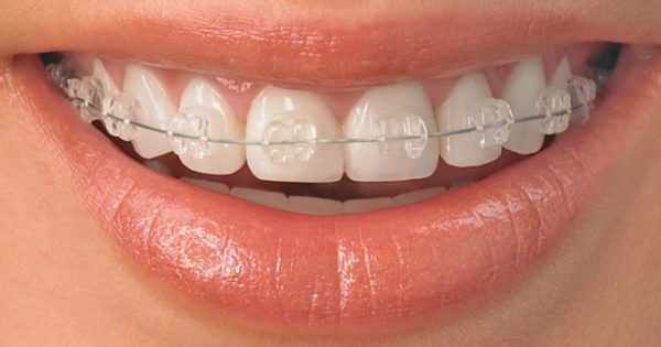 Αραιά δόντια: Που οφείλεται και πως αντιμετωπίζεται η έλλειψη δοντιών
