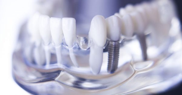 Έλλειψη δοντιών: Πού οφείλεται και πώς αντιμετωπίζεται
