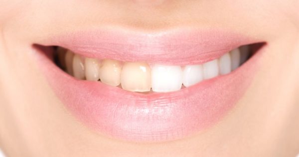 Κίτρινα δόντια: Αντιμετώπιση στο σπίτι με έξυπνες και απλές λύσεις