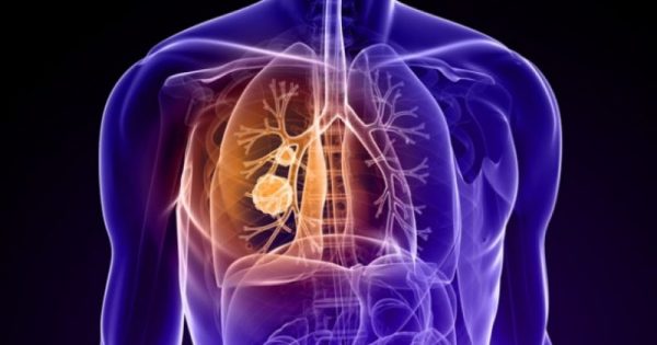 Καρκίνος του πνεύμονα: Προσοχή αν προσeξετε ΑΥΤΗ την αλλαγή στον βήχα σας!!!-ΒΙΝΤΕΟ