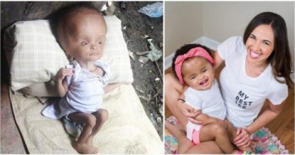 Featured Image for Μωρό με πρησμένο κεφάλι που βρέθηκε εγκαταλελειμμένο στα σκουπίδια σώθηκε και 2 χρόνια μετά λάμπει από χαρά στη νέα του οικογένεια