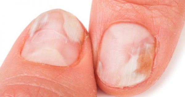 Featured Image for Μύκητες στα νύχια χεριών και ποδιών: Οι 8 κανόνες πρόληψης!!!
