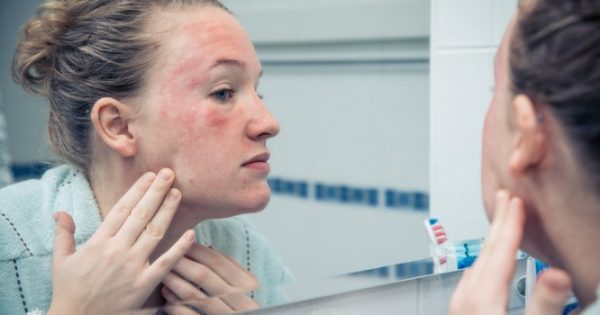 Αλλεργική αντίδραση: Πώς είναι να σας συμβαίνει για πρώτη φορά – Τι να κάνετε άμεσα