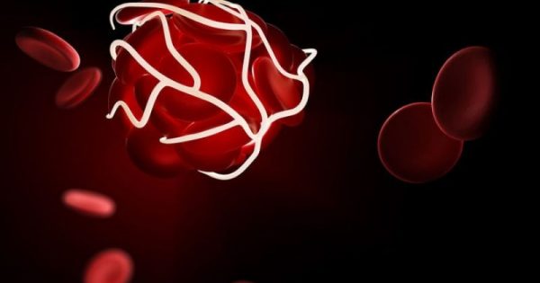 Θρόμβος στο αίμα: 7 σιωπηλά σημάδια που πρέπει να γνωρίζετε!!!ΦΩΤΟ