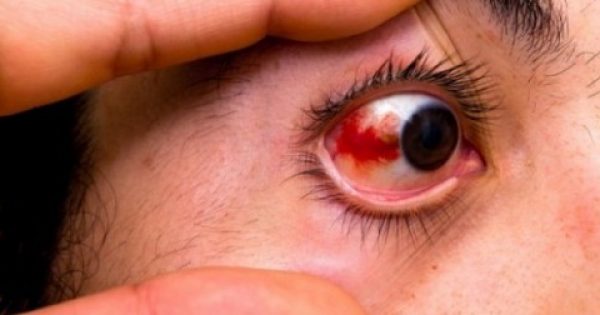 Πού οφείλεται η αιμορραγία στο μάτι;;