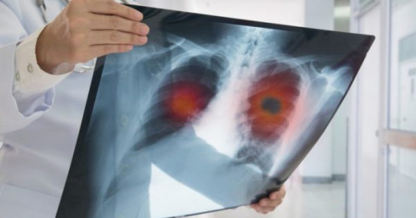 Νέα δεδομένα αλλάζουν το «τοπίο» στην αντιμετώπιση του καρκίνου του πνεύμονα!!!