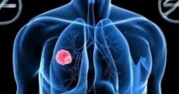 Featured Image for Να τι πρέπει να κάνετε για να μην πάθετε ποτέ καρκίνο του πνεύμονα