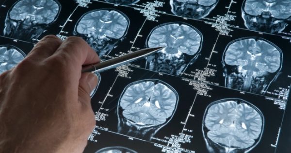 Η χοληστερίνη του εγκεφάλου μπορεί να αυξήσει τον κίνδυνο για Αλτσχάιμερ