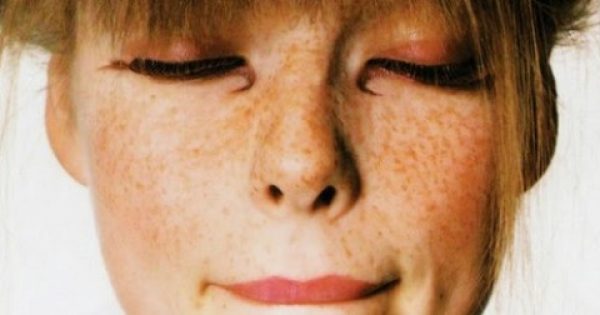 Πανάδες στο πρόσωπο: Πώς θα τις αντιμετωπίσετε