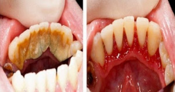 Featured Image for Γίνε ο οδοντίατρος του εαυτού σου! Κόλπα για να καθαρίσεις την πέτρα των δοντιών στο σπίτι σου