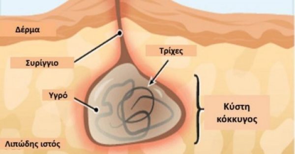 Κύστη κόκκυγος: Γιατί εμφανίζεται και πώς θα την αντιμετωπίσετε