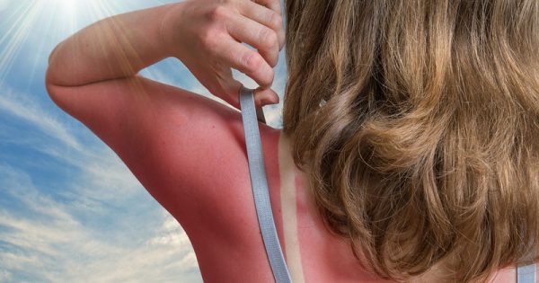 Δηλητηρίαση από τον ήλιο: Ποια συμπτώματα τη διακρίνουν από το ηλιακό έγκαυμα