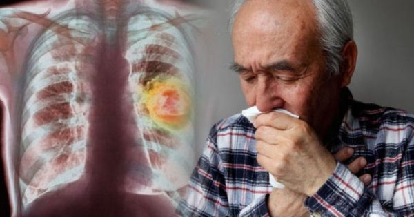 Καρκίνος του πνεύμονα: Μιλήστε άμεσα με τον γιατρό σας αν δείτε αυτό το σημάδι στο φλέγμα σας!!!