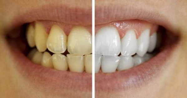 «Μαγικό» διάλυμα με φυσικό τρόπο για τα δόντια – Δείτε «λευκά» αποτελέσματα σε λίγα λεπτά