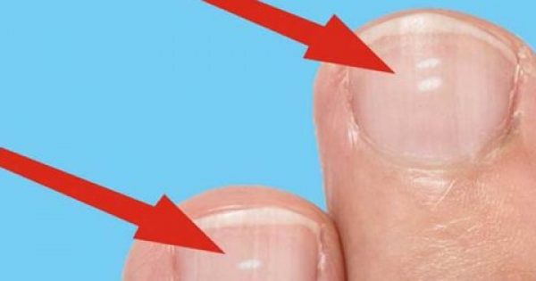 Λευκονυχία: Τι σημαίνουν τα άσπρα σημάδια στα νύχια μας