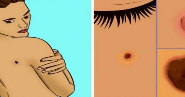 6 συμπτώματα του καρκίνου του δέρματος που δεν πρέπει να αγνοήσετε