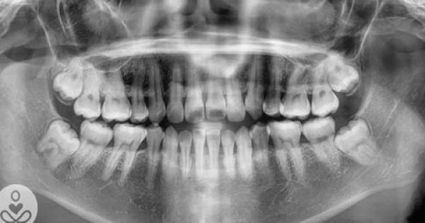Οδοντικά Εμφυτεύματα Τέλος. Πλέον Μπορούμε να Αποκτήσουμε νέα Δόντια σε 9 Μόλις Εβδομάδες
