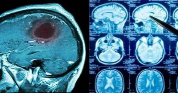 15 σημάδια που δείχνουν οτι μπορεί κάποιος να έχει όγκο στον εγκέφαλο