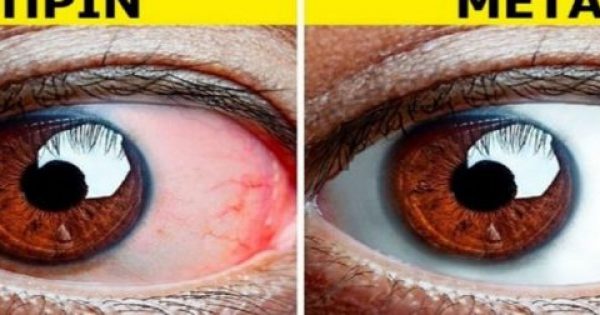 Οι Γιατροί Συμβουλεύουν: 8 Πράγματα που Πρέπει να Κάνουν Όλοι όσοι Έχουν Κουρασμένα Μάτια
