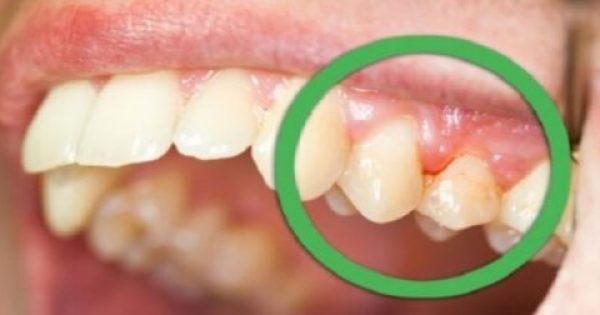 Φυσικές θεραπείες για ούλα που ματώνουν και δόντια που κουνιούνται