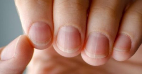 Πέντε ύπουλα προβλήματα υγείας που φαίνονται στα νύχια