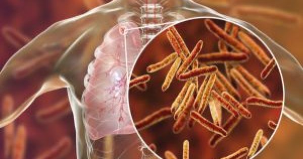 Τι πρέπει να ξέρετε για την φυματίωση: Συμπτώματα, πώς κολλάει και τι θεραπεία έχει!!!
