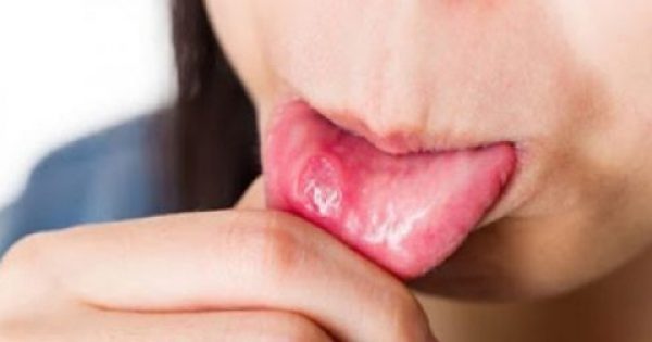 Featured Image for Άφθες στο στόμα: Το λαχανικό που τις εξαφανίζει