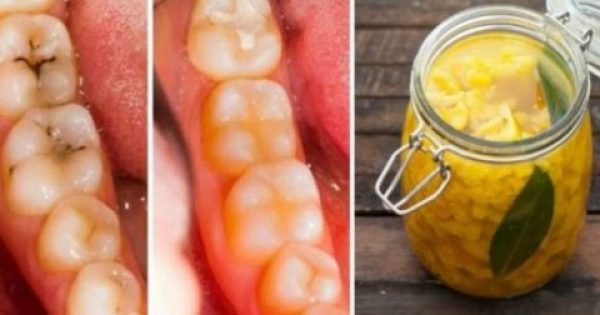 Πως να θεραπεύσετε την τερηδόνα και τις «κουφάλες» στα δόντια με φυσικό τρόπο: 3 απλές και αποτελεσματικές θεραπείες