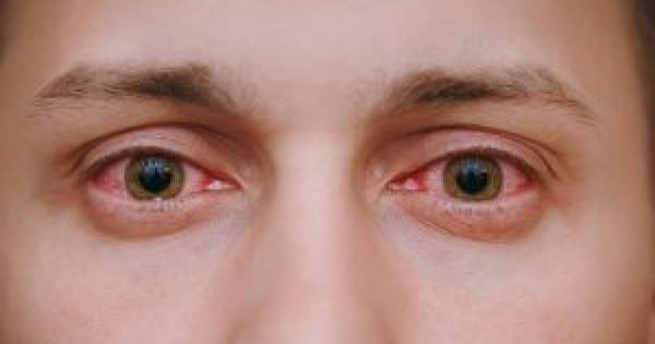 Featured Image for Κοκκίνισμα ματιών: 5 κοινές αιτίες και πώς θα το προλάβετε!!!