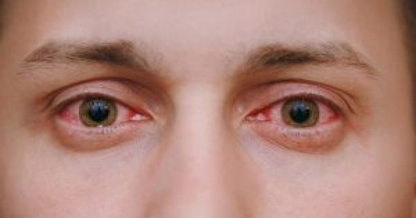 Κοκκίνισμα ματιών: 5 κοινές αιτίες και πώς θα το προλάβετε!!!