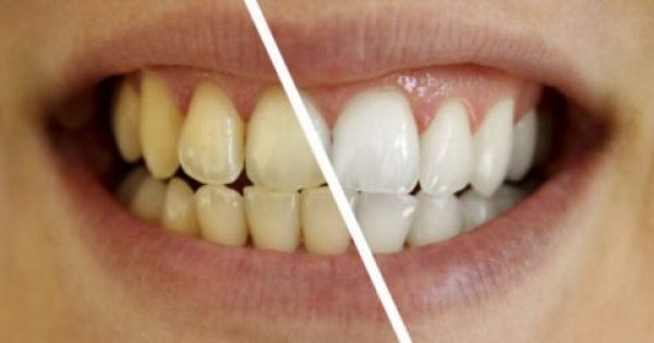 Το “Μαγικό” Διάλυμα Για Πιο Αστραφτερά Δόντια Με Το Βούρτσισμα
