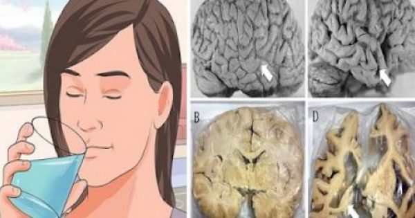 Έρευνα: Τι προκαλεί στον εγκέφαλο το Αλουμίνιο & πως να το απομακρύνετε!