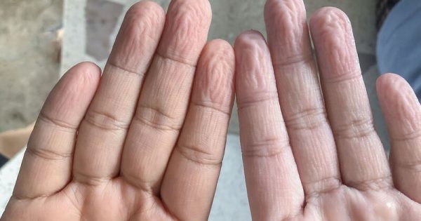 Featured Image for Γιατί ζαρώνουν τα δάχτυλα όταν μένουν πολλή ώρα στο νερό;
