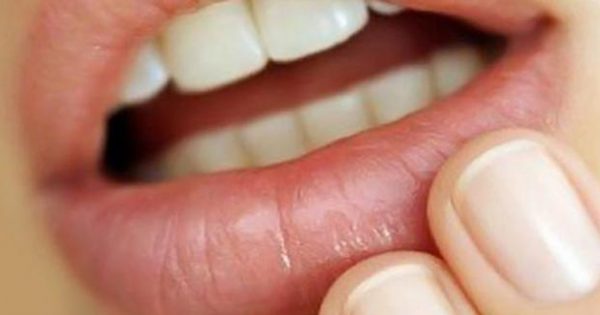 Άφτρες στο στόμα – Φυσικοί τρόποι αντιμετώπισης